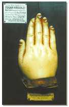 Onicomicose - Face posterior da mão direita