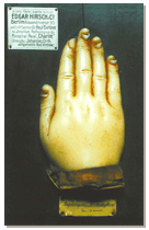 Onychomycosis - Posterior face of the right hand